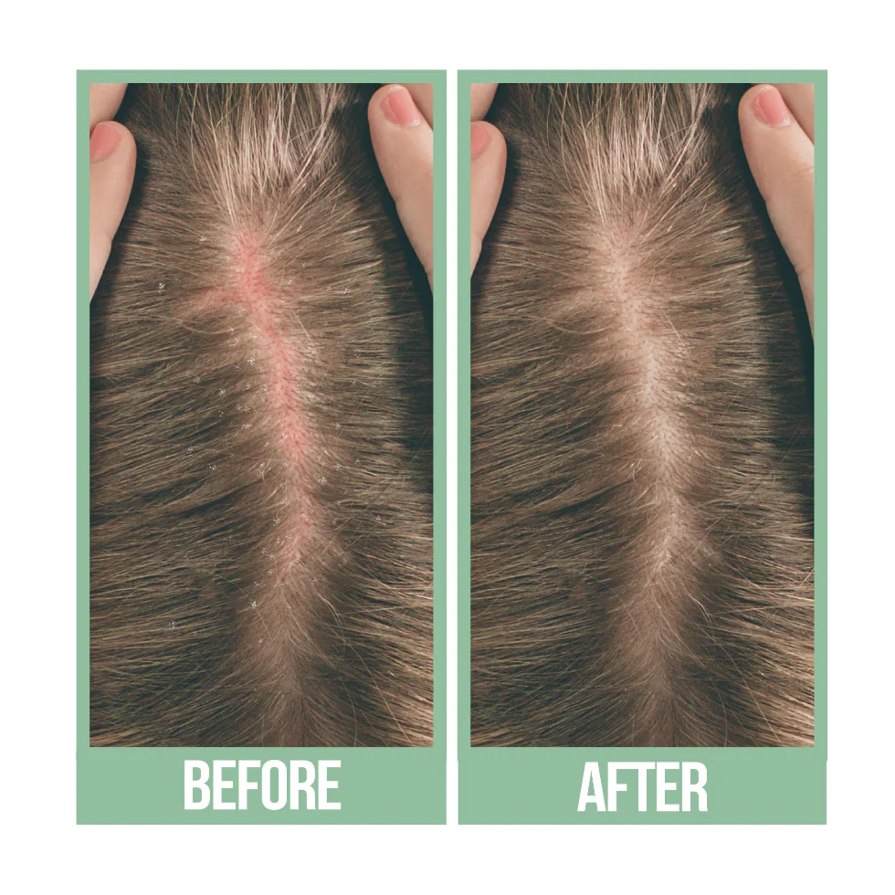 Difeel Tea Tree Hair Oil 8oz | Soothes Itchy Scalp & Strengthens Hair - Image 2